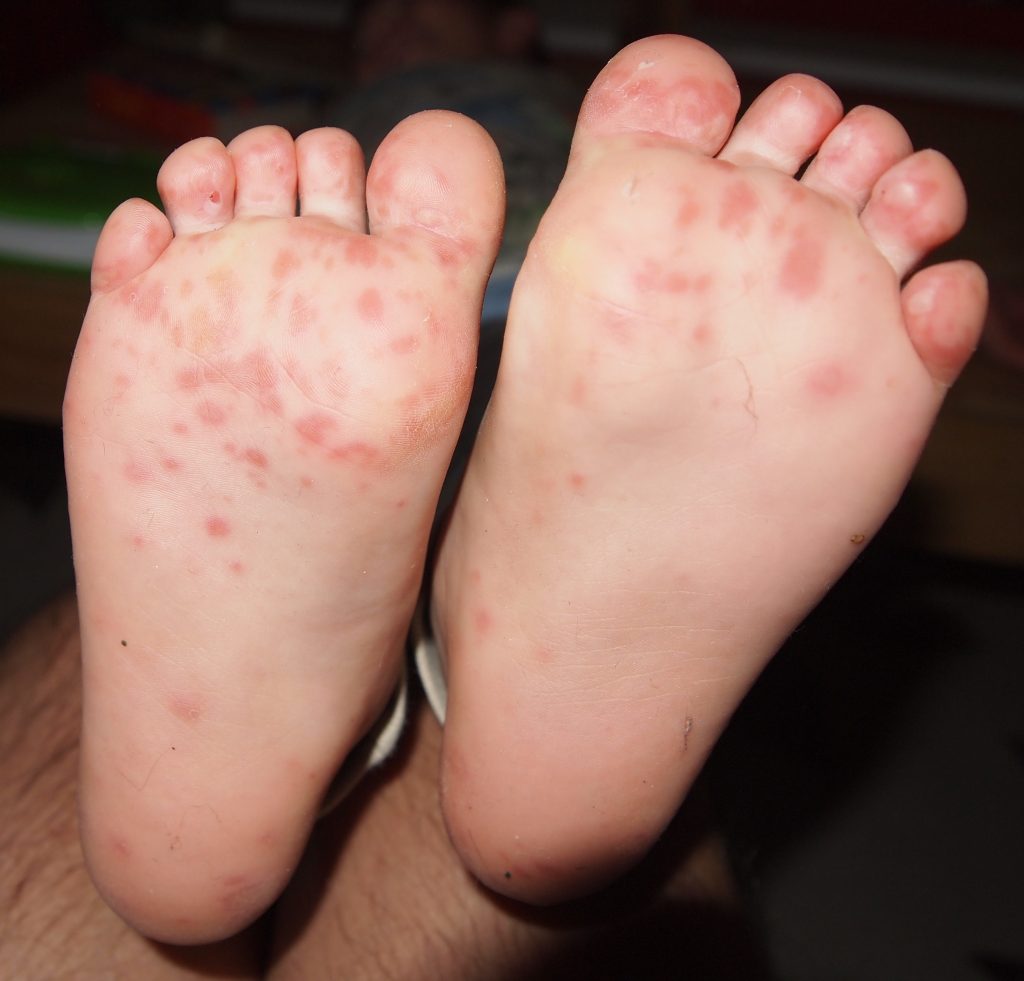 hfmd rashes